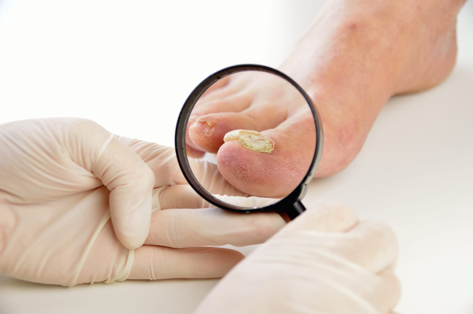 onicomicosis-tratamiento-bivok